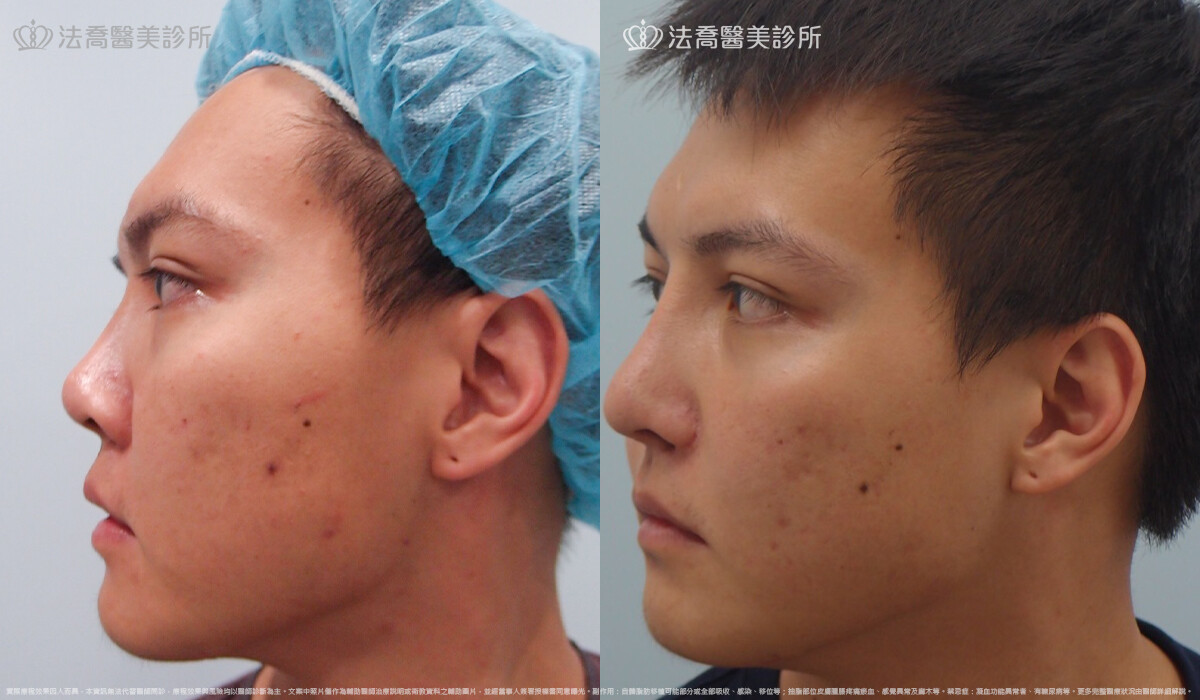 goretex隆鼻,法喬醫美診所,邱浚彥