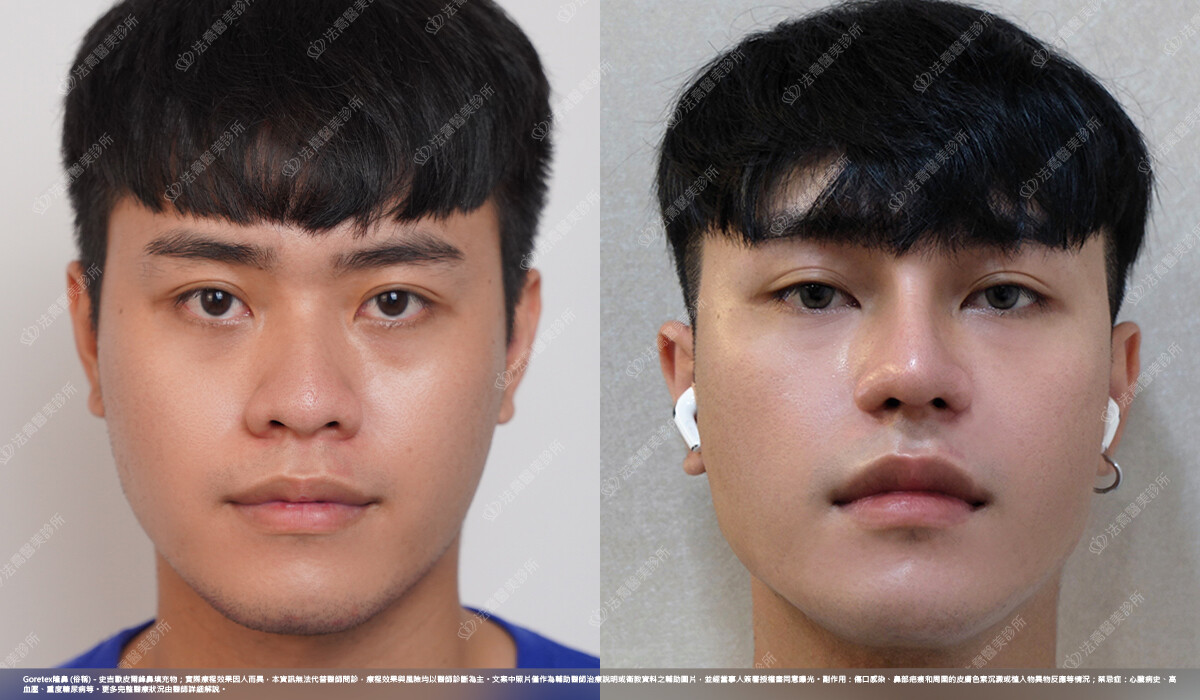 Goretex隆鼻 、縮鼻翼