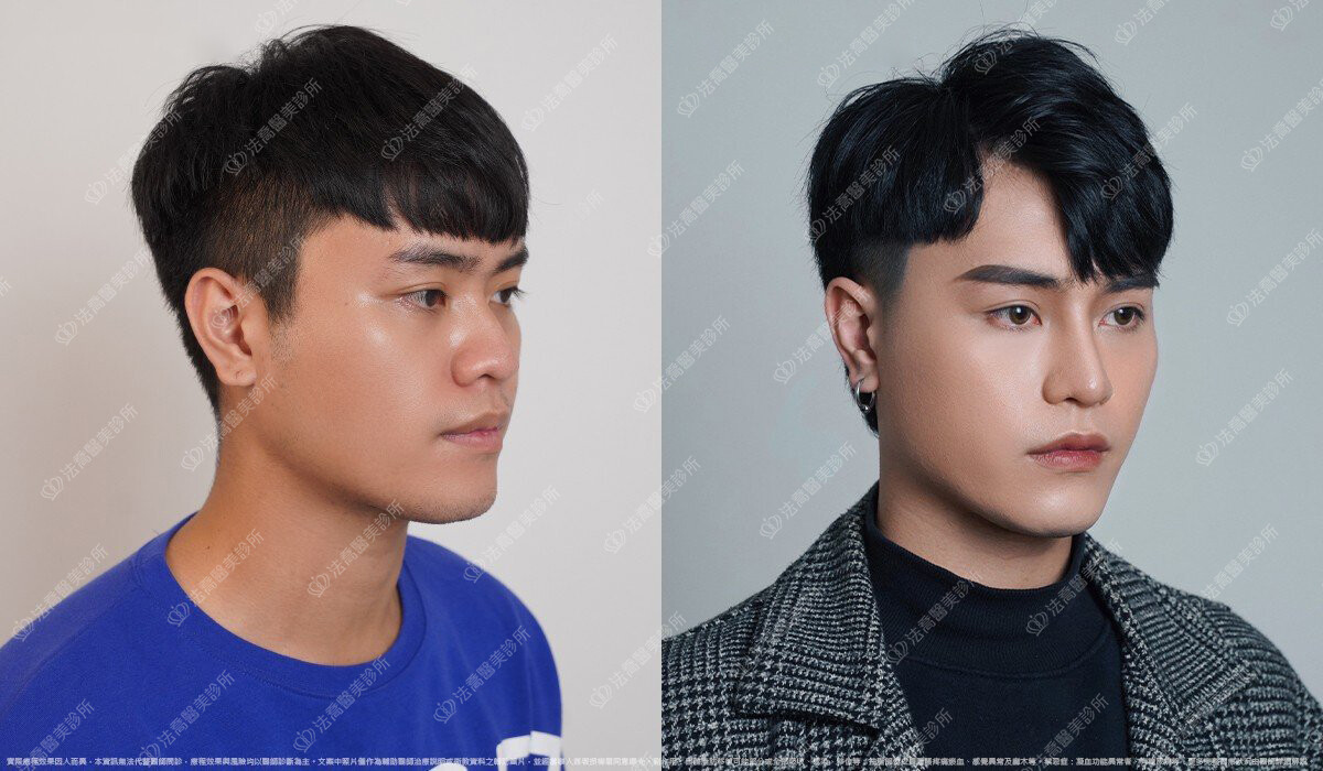 Goretex隆鼻 、縮鼻翼