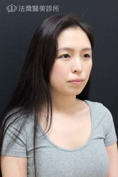 自體肋骨隆鼻