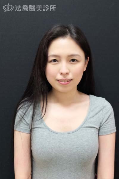 自體肋骨隆鼻
