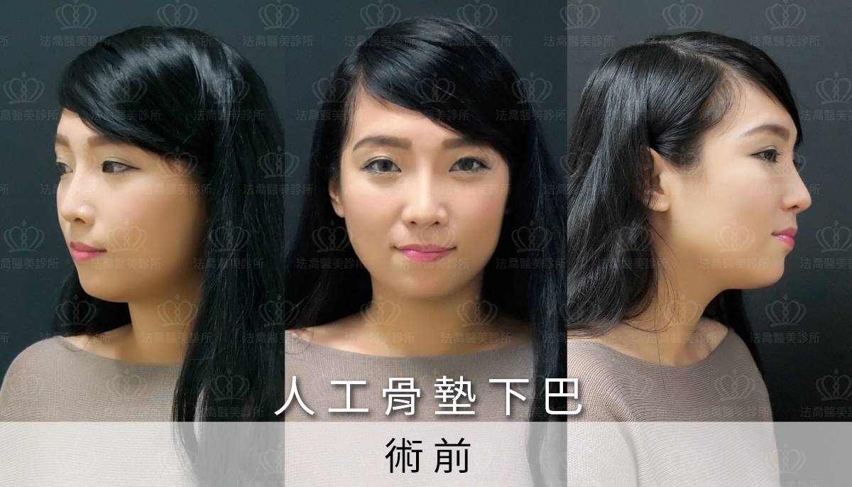 /files/images/案例分享/墊下巴/Eva/(術前)Eva_人工骨墊下巴.jpg?1563274319