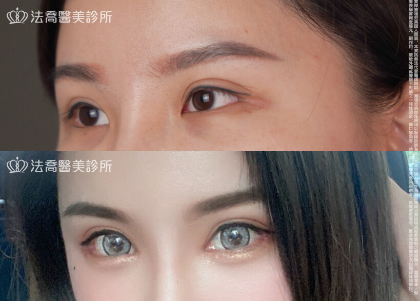 開眼頭、開眼尾、眼尾下置術