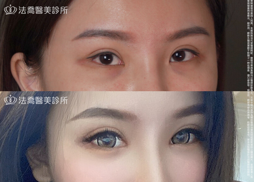 開眼頭、開眼尾、眼尾下置術