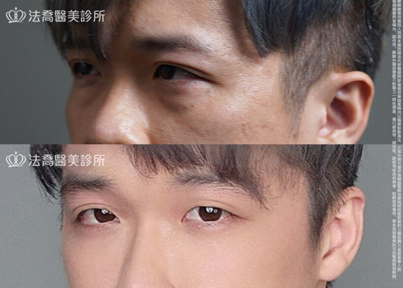 眼袋內開、脂肪移位 術前與術後1個月