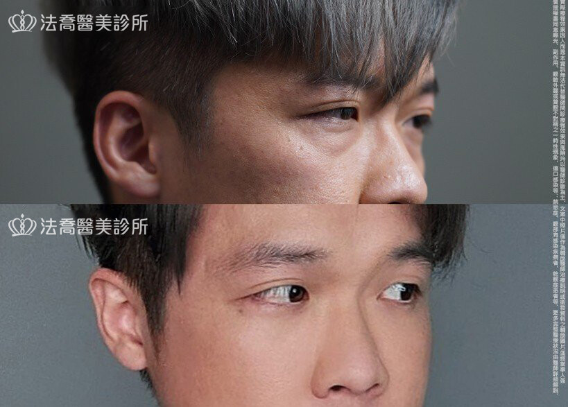 眼袋內開、脂肪移位 術前與術後1個月