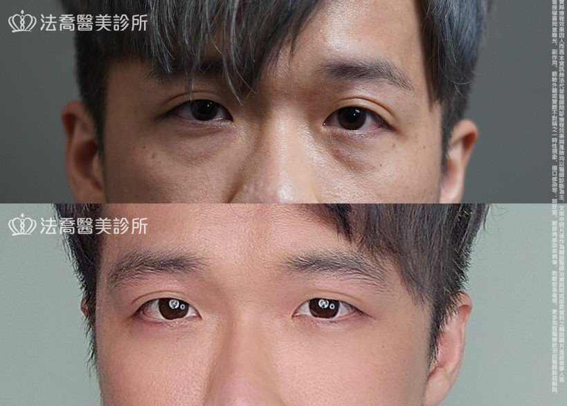 眼袋內開、脂肪移位 術前與術後1個月