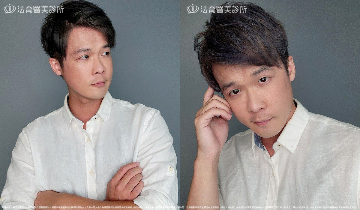 眼袋內開 脂肪移位 術後一個月 生活照