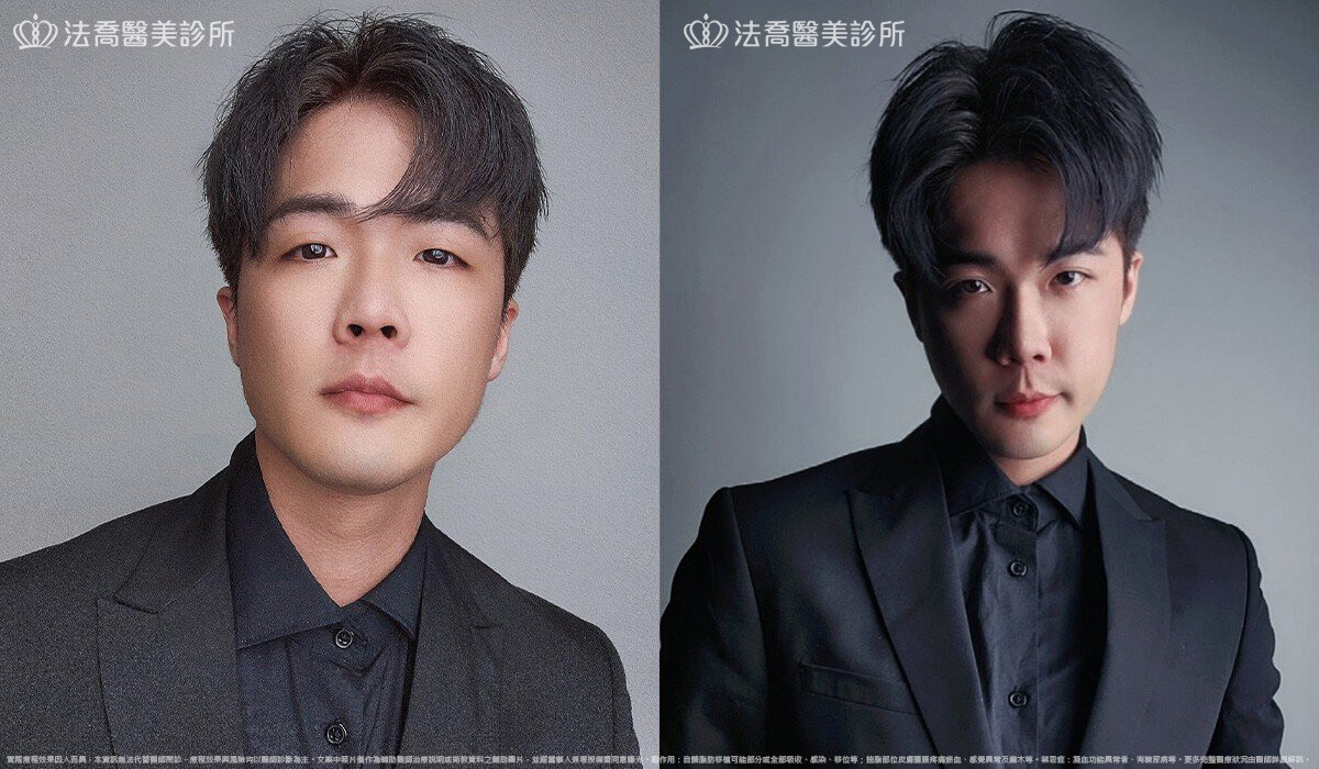 眼袋內開、脂肪移位 術後3個月