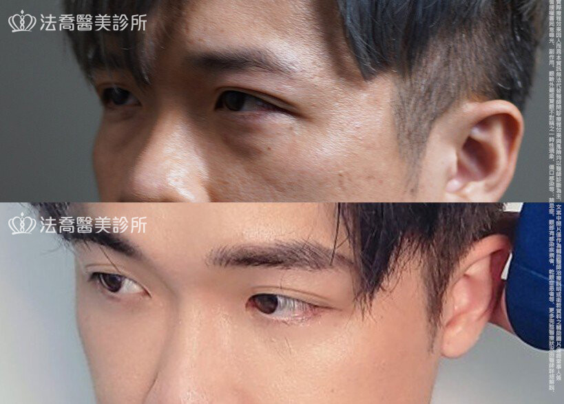眼袋內開、脂肪移位 術前與術後3個月