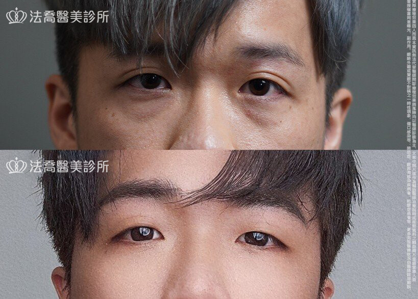 眼袋內開 脂肪移位 術前與術後3個月