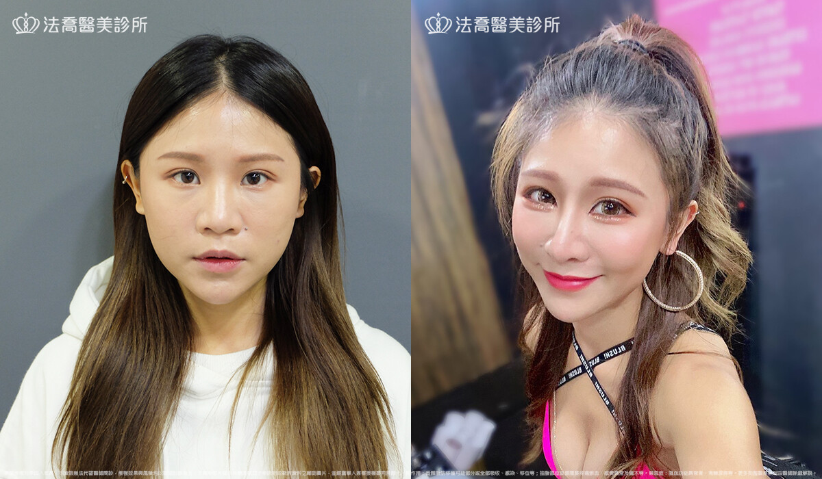法喬醫美診所,邱浚彥,自體肋骨隆鼻