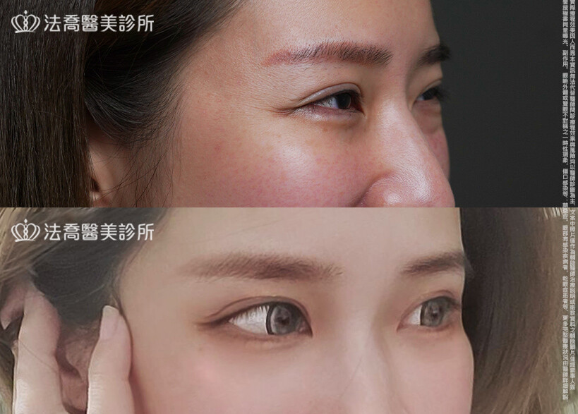 眼袋內開、脂肪移位 術前與術後1個月
