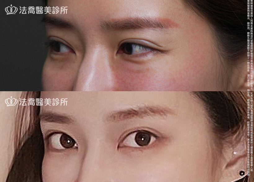 眼袋內開、脂肪移位 術前與術後1個月