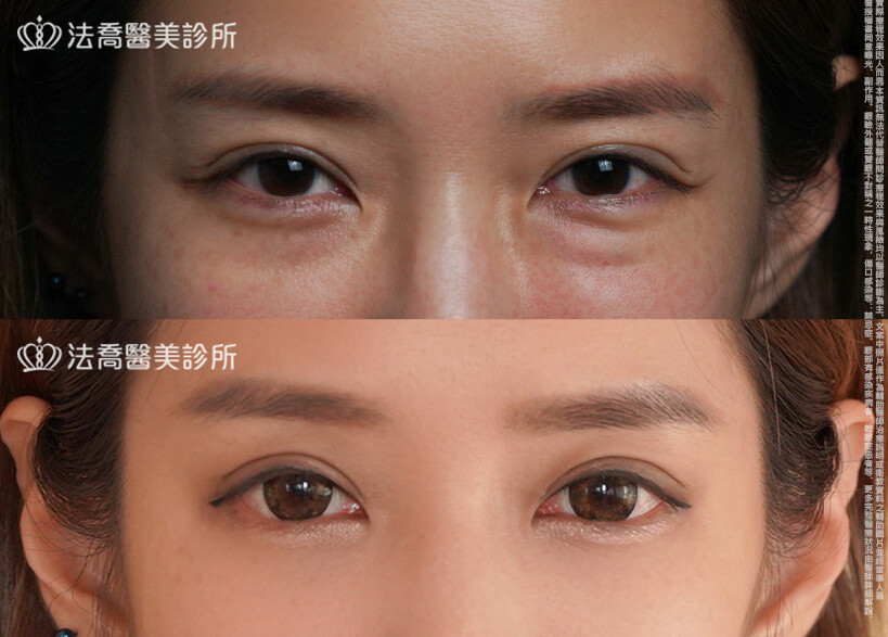 眼袋內開 脂肪移位 術前與術後3個月