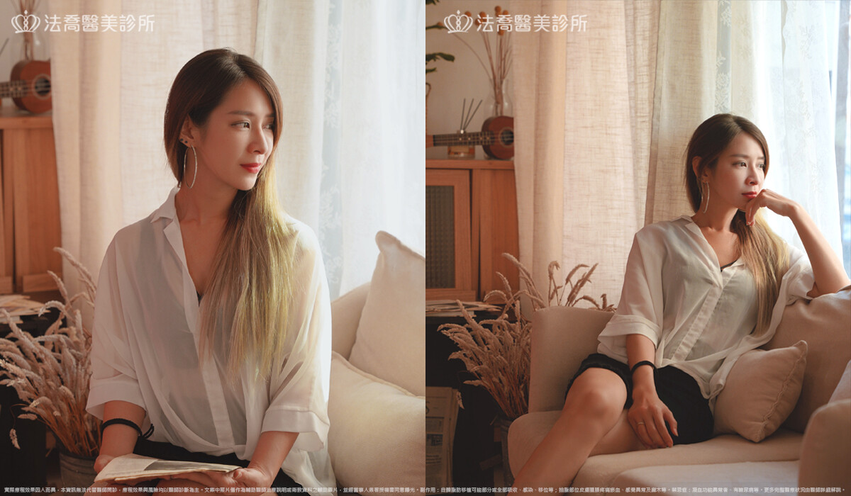 眼袋內開、脂肪移位 術後4個月