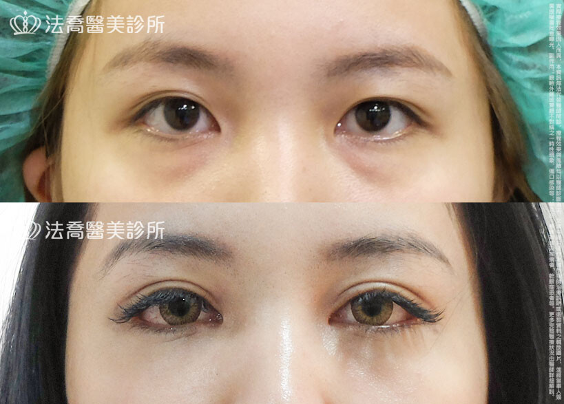 割雙眼皮
