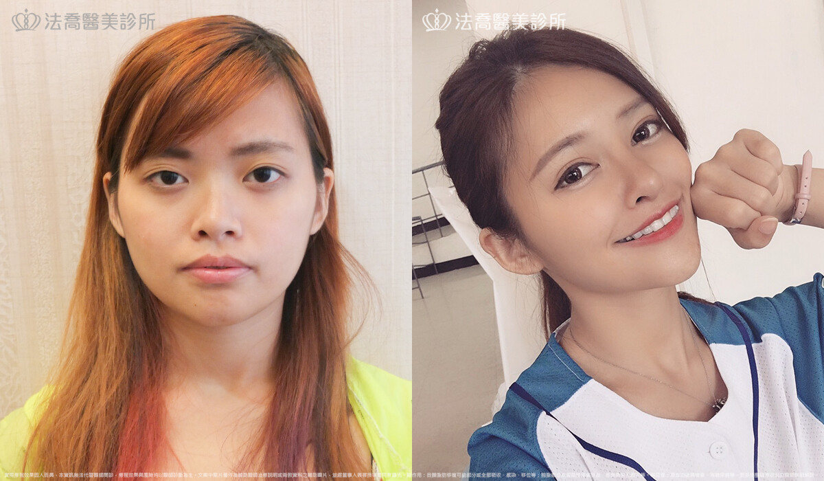 法喬醫美診所,邱浚彥,自體肋骨隆鼻