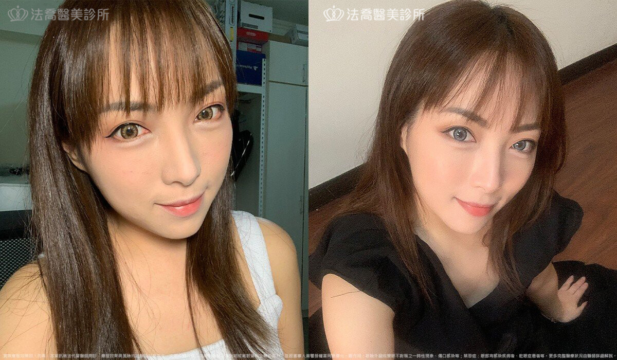 眼袋內開 脂肪移位 術後1個月