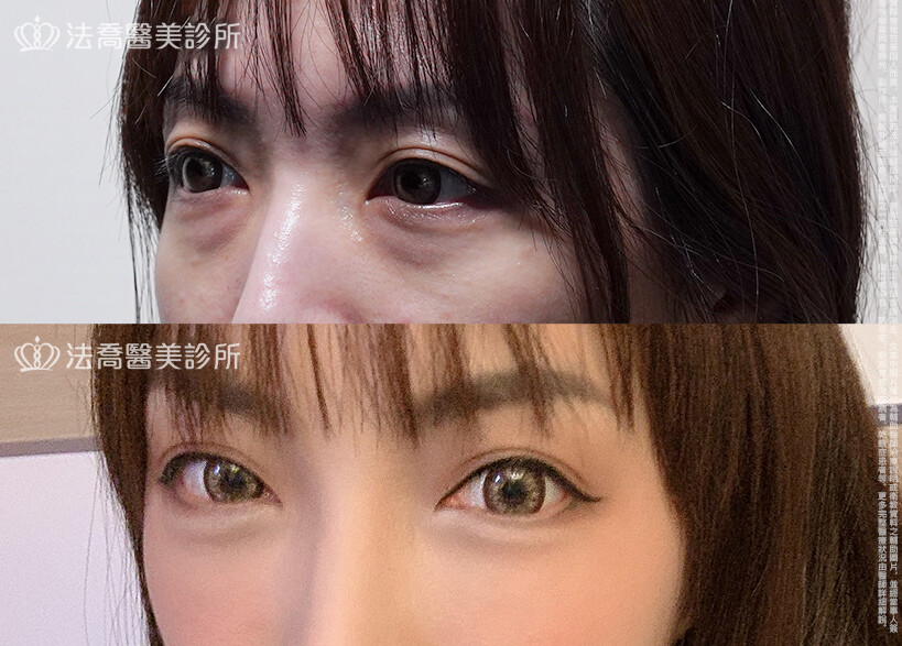 眼袋內開、脂肪移位 術前與術後1個月