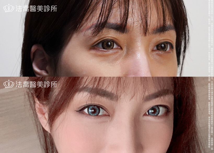 眼袋內開、脂肪移位 術前與術後3個月