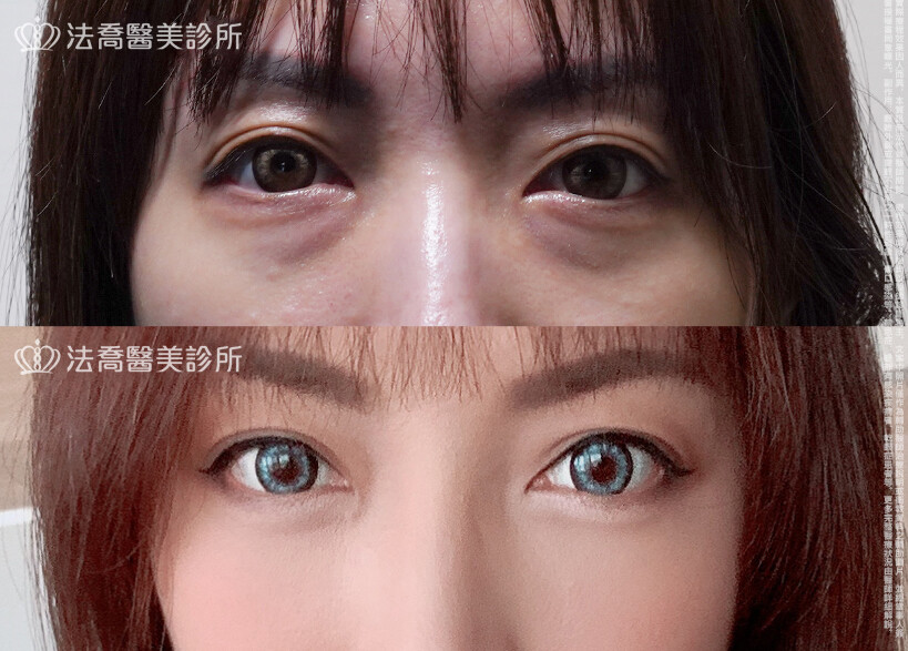 眼袋內開 脂肪移位 術前與術後3個月