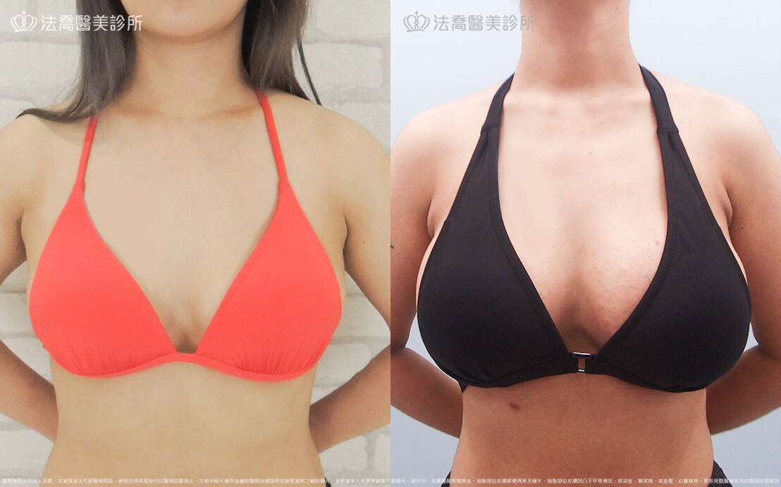 法喬醫美診所,邱浚彥,超音波複合式隆乳