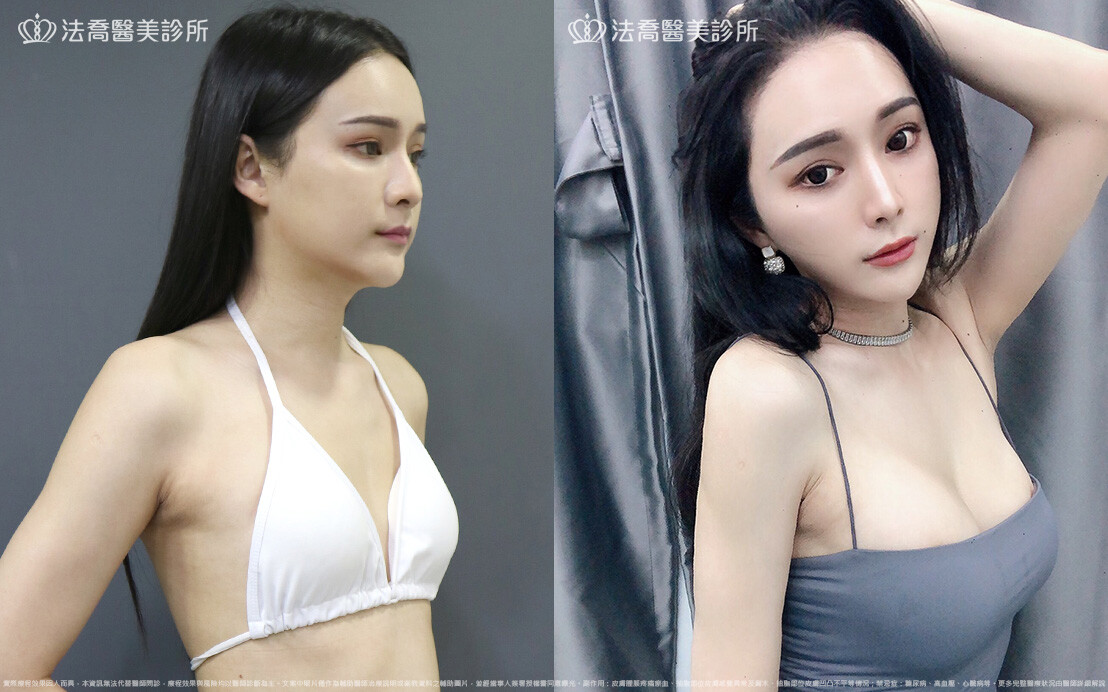 隆乳合併自體脂肪豐胸