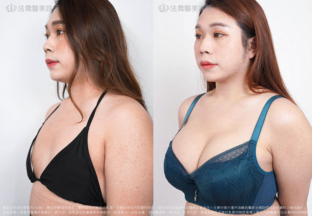 兔兔隆乳術後6個月B