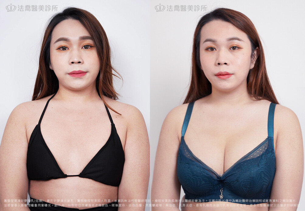 兔兔隆乳術後6個月A