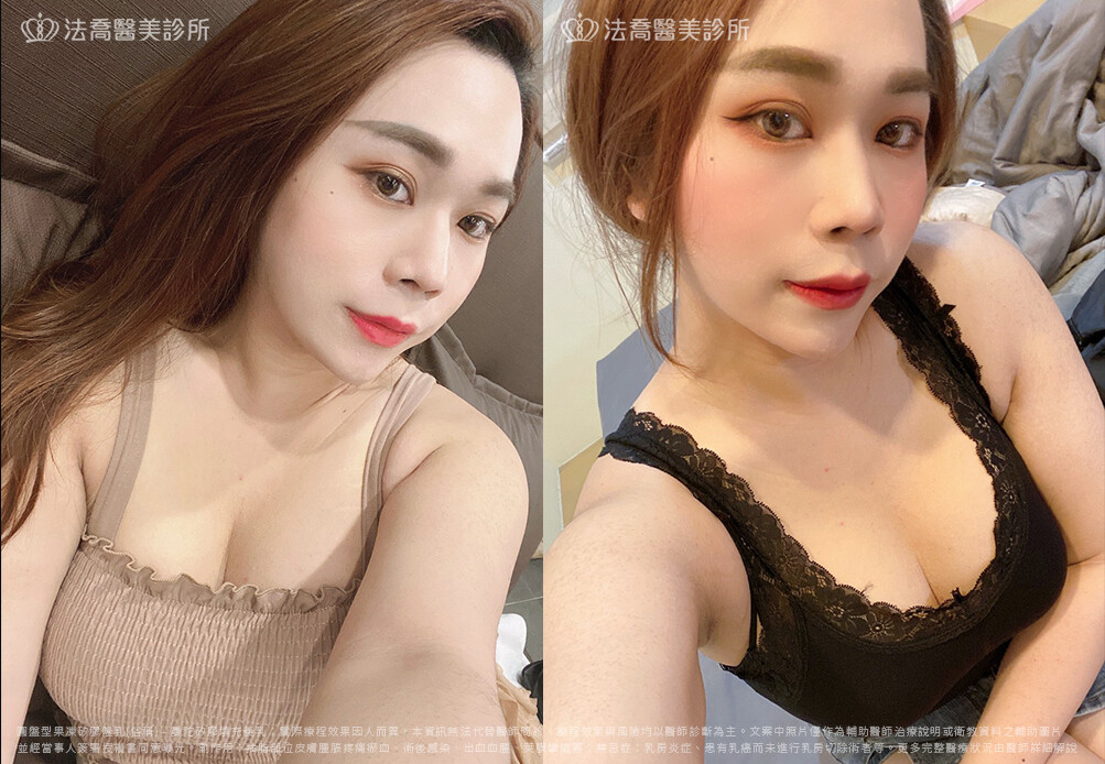 兔兔隆乳術後3M生活照