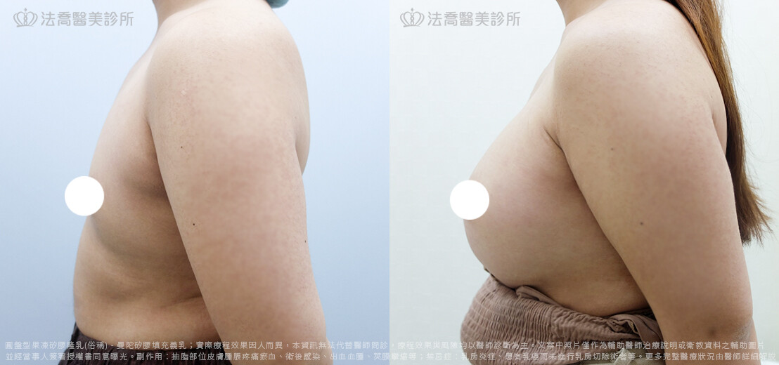 兔兔隆乳術後3個月D