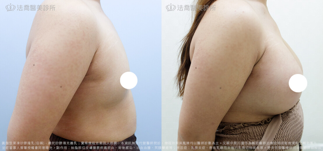 兔兔隆乳術後3個月C