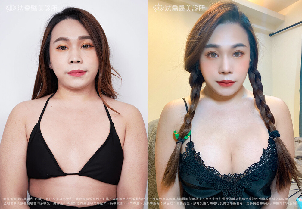 兔兔隆乳術後3個月A