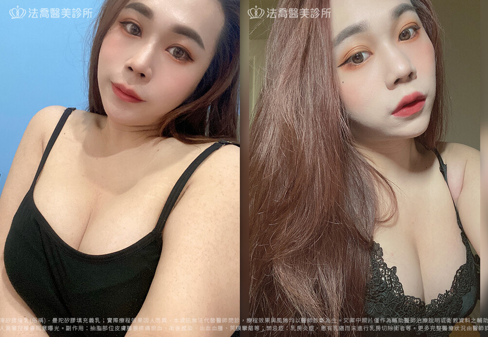 兔兔隆乳術後1個月生活照