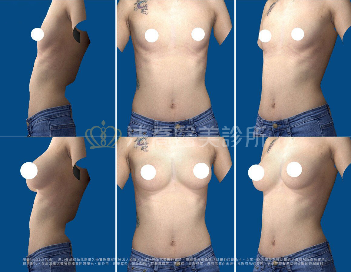 法喬醫美診所,邱浚彥,魔滴隆乳,隆乳推薦