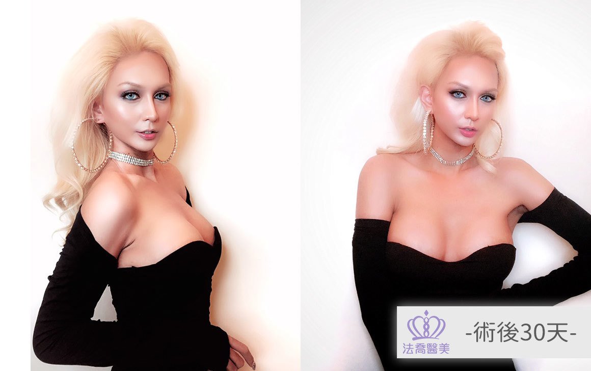 法喬醫美診所複合式隆乳