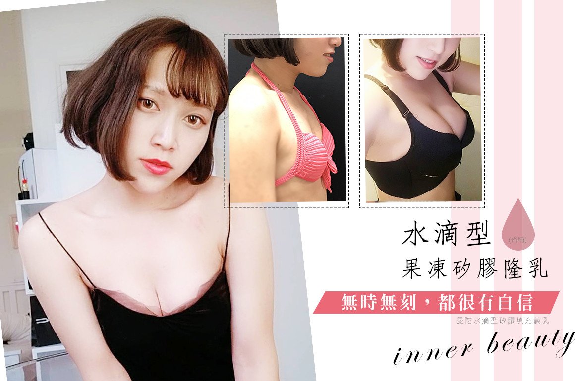 法喬隆乳案例