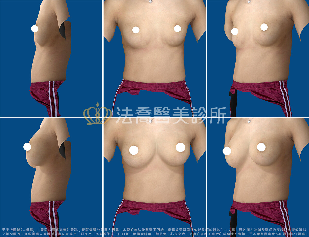 法喬醫美診所邱浚彥醫師隆乳模擬