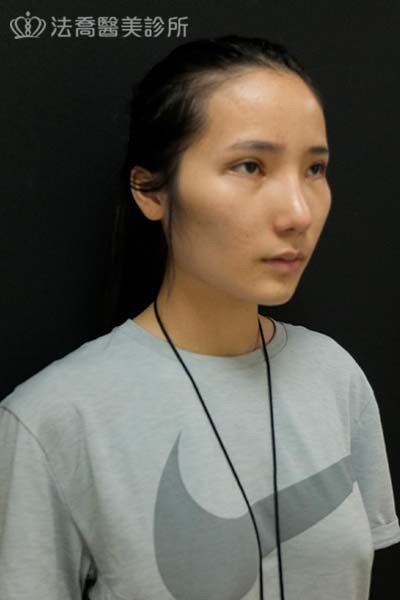 自體肋骨隆鼻