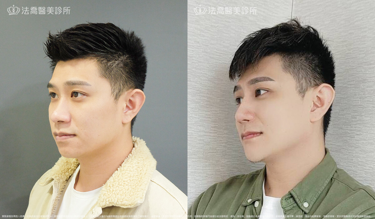 法喬醫美診所,邱浚彥,自體肋骨隆鼻