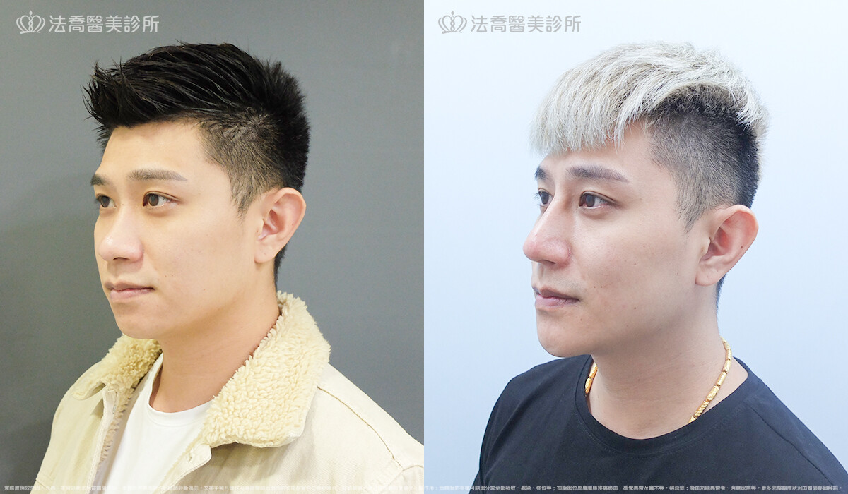 法喬醫美診所,邱浚彥,自體肋骨隆鼻