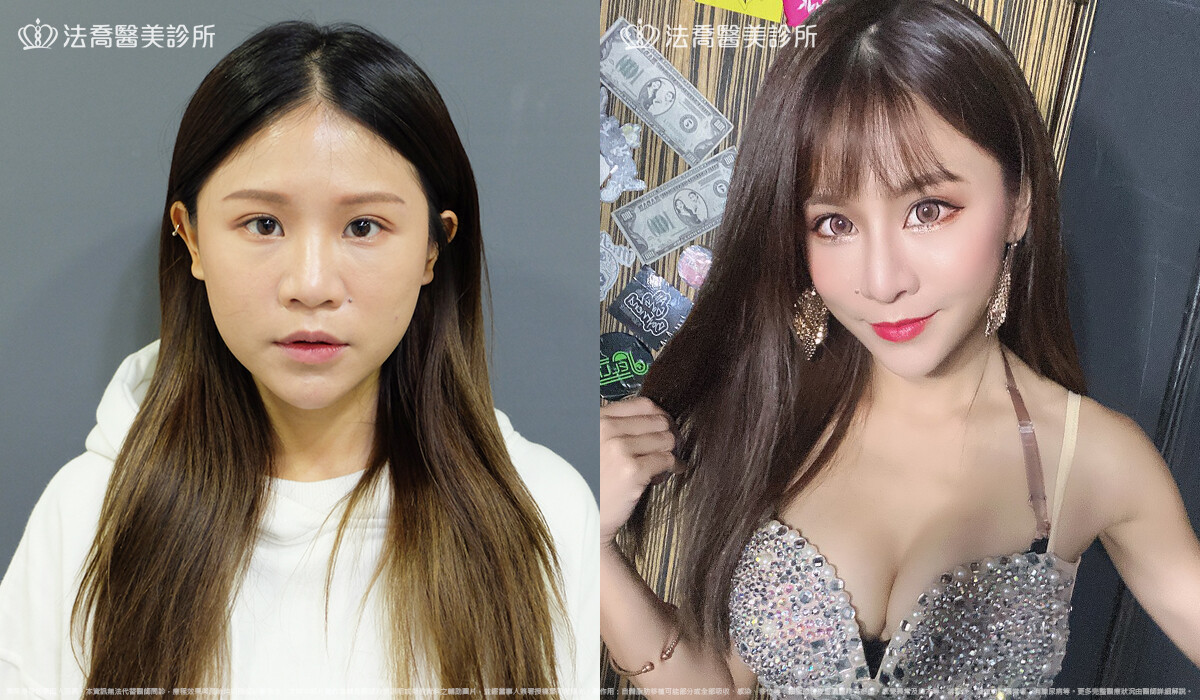 法喬醫美診所,邱浚彥,自體肋骨隆鼻