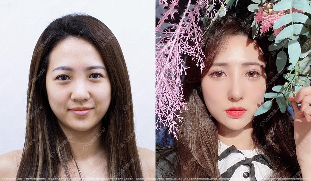 法喬醫美診所邱浚彥醫師切眉手術