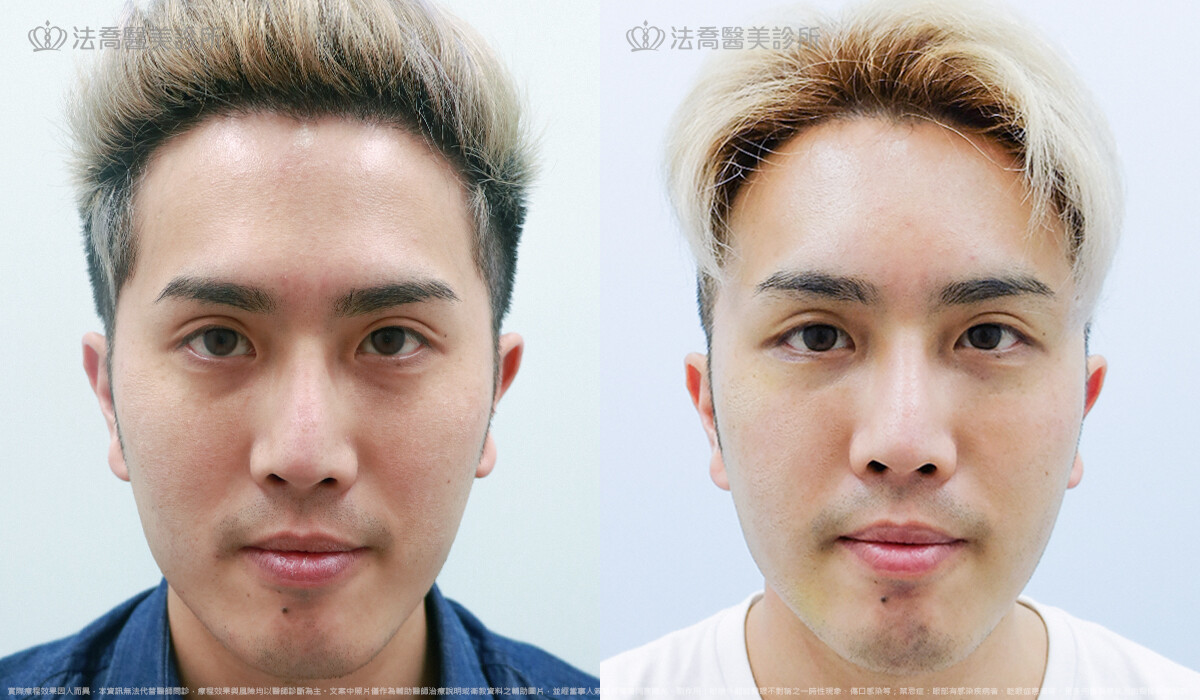 法喬醫美診所,邱浚彥,PICOCARE皮秒雷射