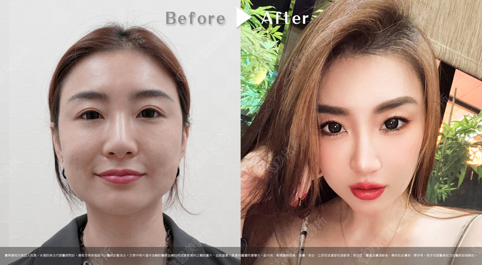 PICOCARE 皮秒雷射 術前術後