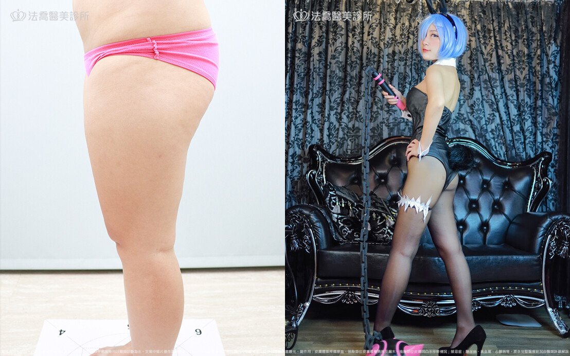 法喬醫美診所,邱浚彥,威塑大腿環抽