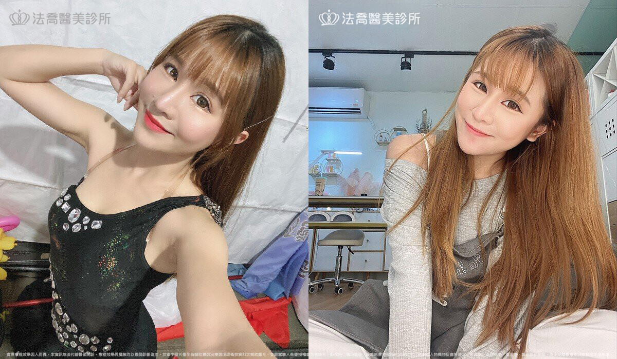 法喬醫美診所,邱浚彥,自體肋骨隆鼻