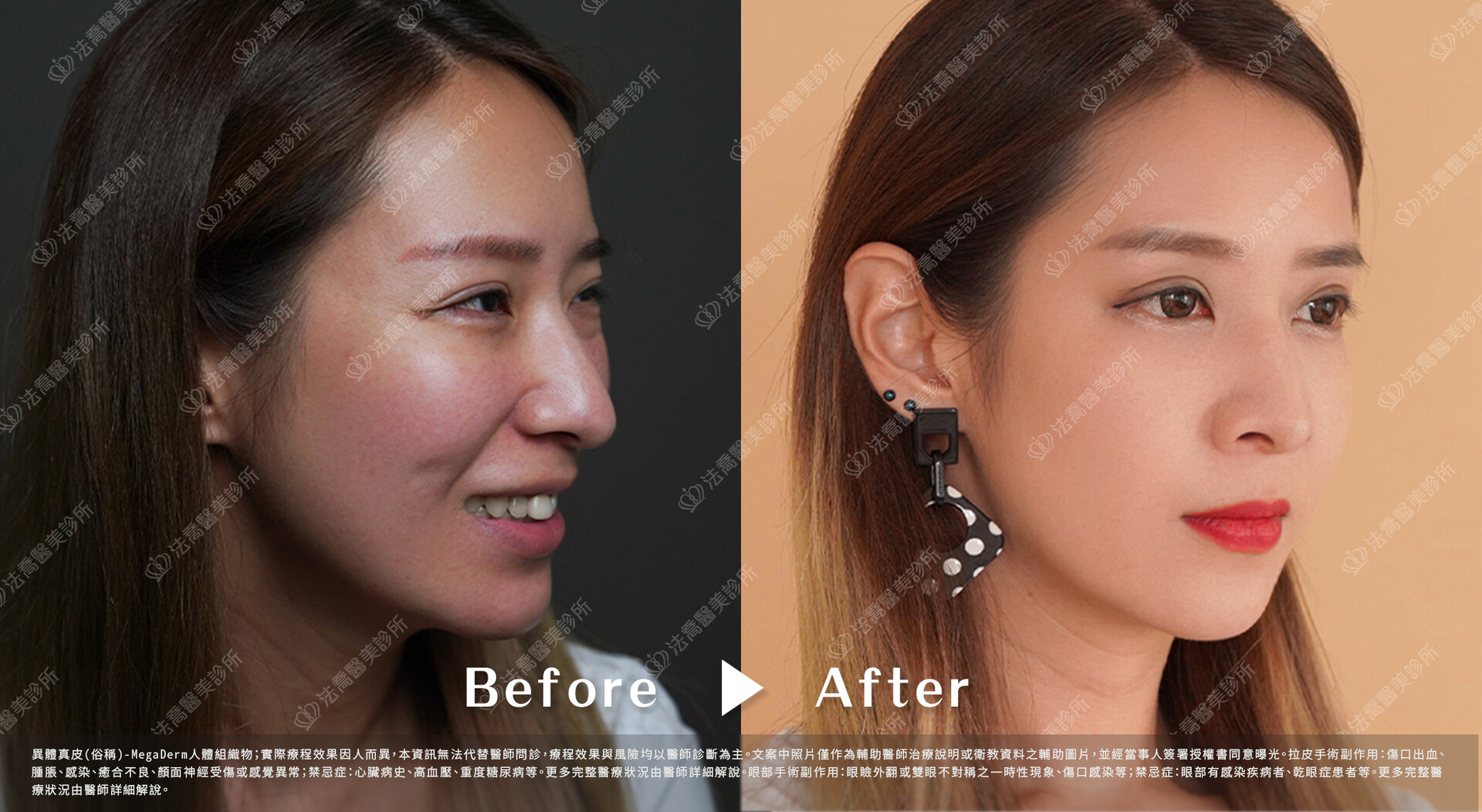 異體真皮鼻唇溝(法令)填補術 術前與術後3個月