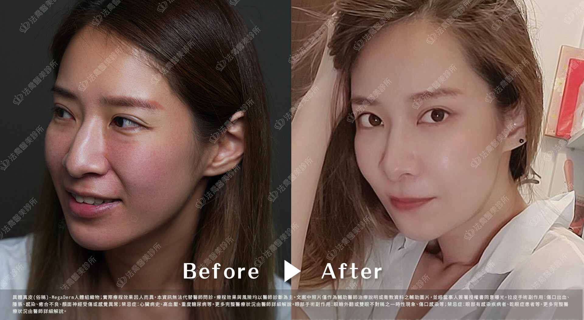 異體真皮鼻唇溝 術前與術後1個月